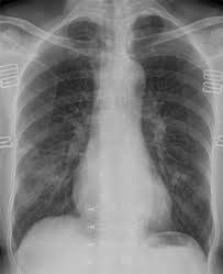 In fact every radiologst should be an expert in chest film reading. Chest X Rays Show More Severe Covid 19 In Non White Patients Imaging Technology News