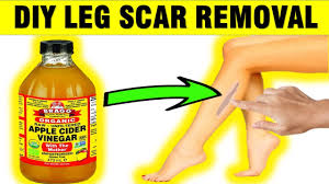 remove scars and dark spots on legs