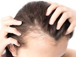Female Pattern Baldness Causes Treatment And Prevention