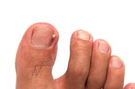 tackling ingrown toenails