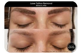 laser tattoo removal in amherst