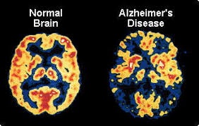 neuroscience for kids alzheimer s disease