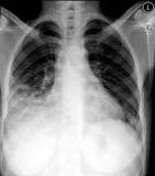 Image result for icd 10 code for rul pneumonia