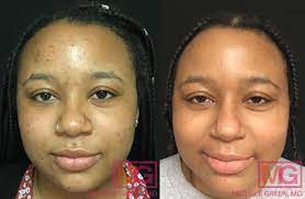 acne dark spot treatment dr michele