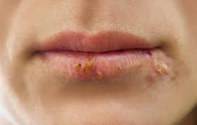 are cold sores conious how long are