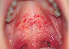 lesions in children and
