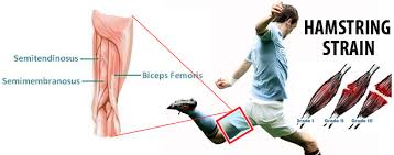 Muscles semitendinosus and semimembranosus are directed. Hamstring Injury Causes Symptoms And Treatment