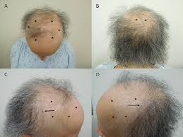 persistent alopecia in a t cancer