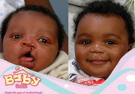 treatment options for cleft lip and