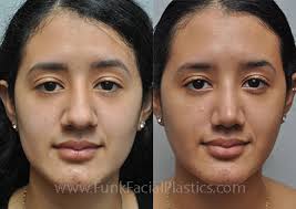 bulbous nose rhinoplasty nose tip