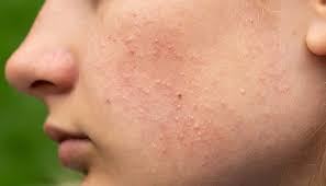 fungal acne the reason your acne