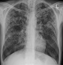 Tuberculosis is curable and preventable. Miliary Tuberculosis Wikipedia