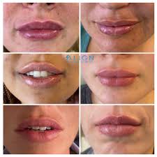 faq lip injections align injectable