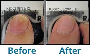 lunula fungal nail cold laser treatment
