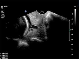 cervical length in preterm labor