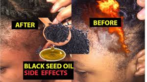 What is black seed oil? How To Use Black Seed Oil For Hair Growth And Prevent Hair Fall Youtube