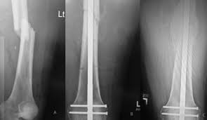 fracture healing of the left femur at