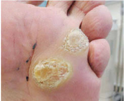 Acid can be applied either as a. Plantar Wart Home Remedies The Ugly Truth Adelaide Podiatry