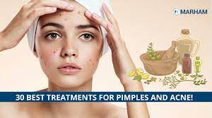 how to remove pimples naturally and