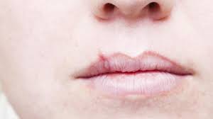 cold sores 9 things to know
