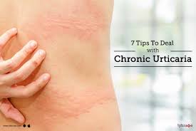 chronic urticaria or hives