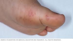 Itching is a common symptom and it can be caused by a number of for example, people with severe allergic reactions or kidney disease can have itching without rash along with one or more of those symptoms. Hand Foot And Mouth Disease Symptoms And Causes Mayo Clinic