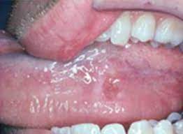 In the early stages, mouth cancer may cause no pain. Oral Cancer Images The Oral Cancer Foundation