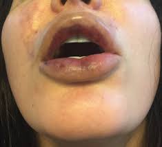 necrosis after juvederm injection to