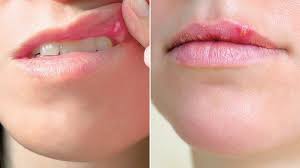 cold sore home remes and treatment