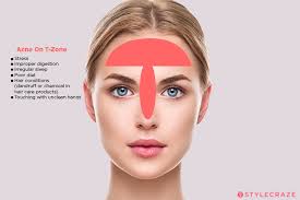Zits On Face Map Get Rid Of Wiring Diagram Problem