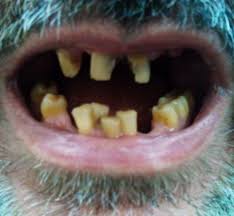 Tooth Discoloration Wikipedia