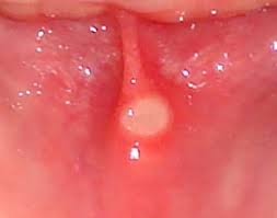 canker sore treatments causes and