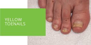 yellow toenails causes and treatment