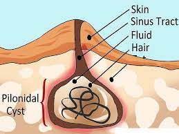 pilonidal sinus causes symptoms and