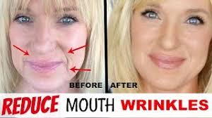 mouth wrinkles without fillers