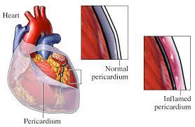 The chest pain occurs when the irritated layers of the pericardium rub against each other. Pericarditis Cormedicalgroup Com