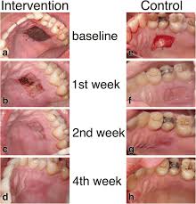 palatal wound dressing and healing over