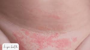 diaper rash from baby yeast infections