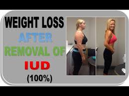 weight loss after iud removal a must
