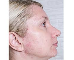 acne subcision carlsbad encinitas