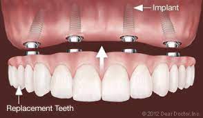 fixed dentures