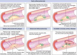 Pathogenesis Of Atherosclerosis Vascular Disease