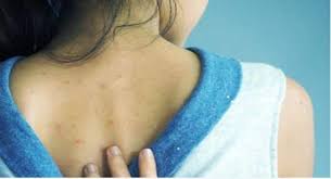 want to get rid of back acne here are
