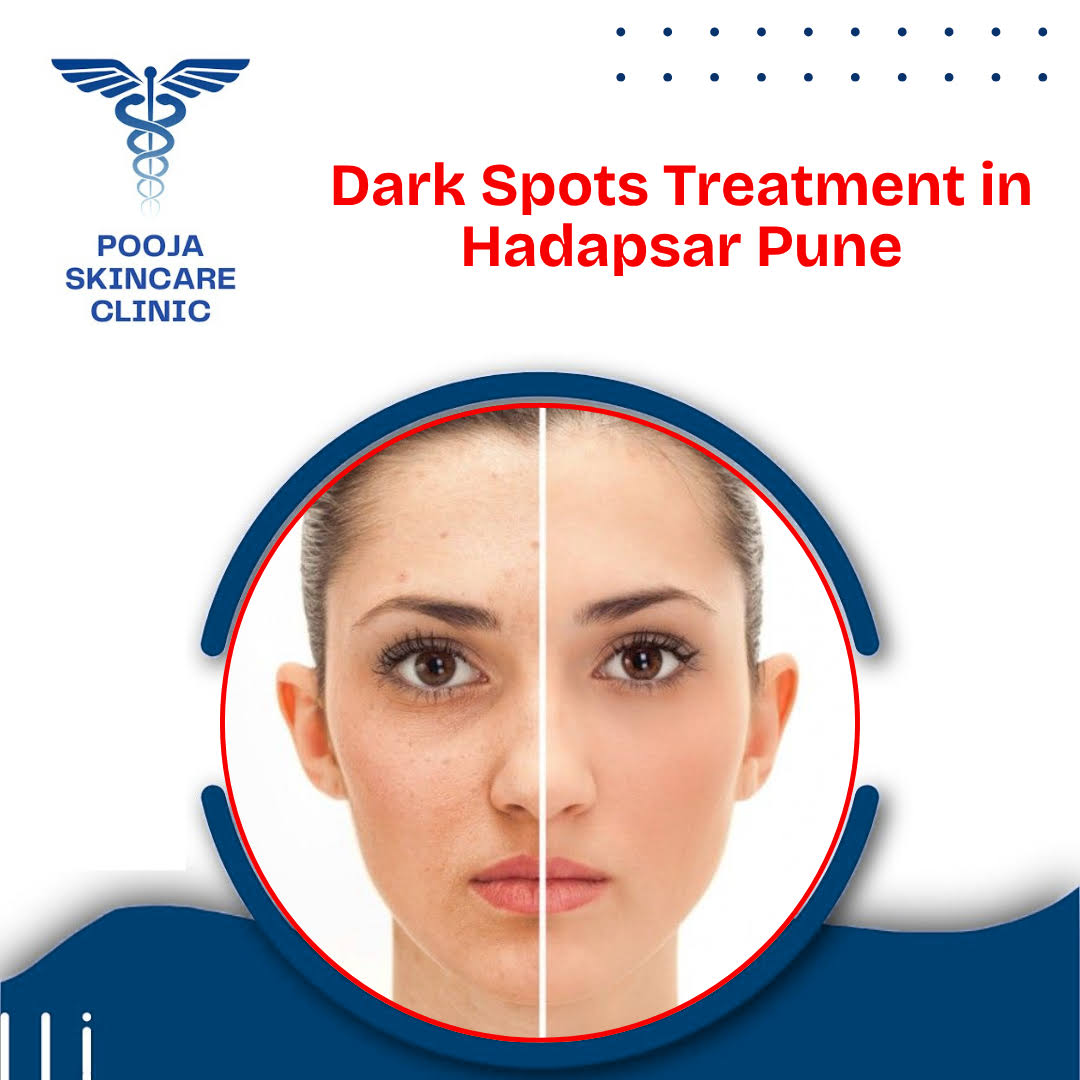 Dark Spots Treatment in Hadapsar Pune product image