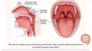 tonsil removal and myofunctional