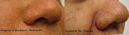 sebaceous hyperplasia removal with