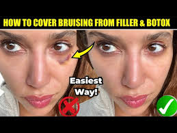 how to cover bruising from fillers and