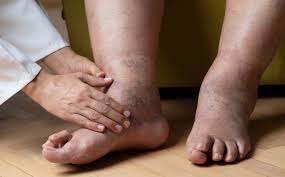 diabetic foot issues wound care
