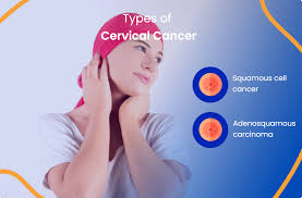 cervical cancer everything you need to