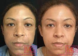 microneedling for skin tightening dr